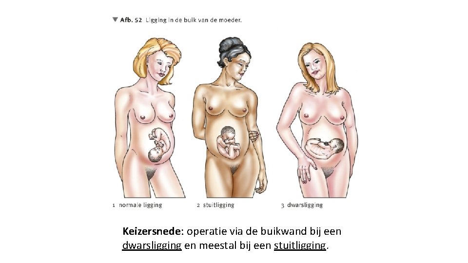 Keizersnede: operatie via de buikwand bij een dwarsligging en meestal bij een stuitligging. 