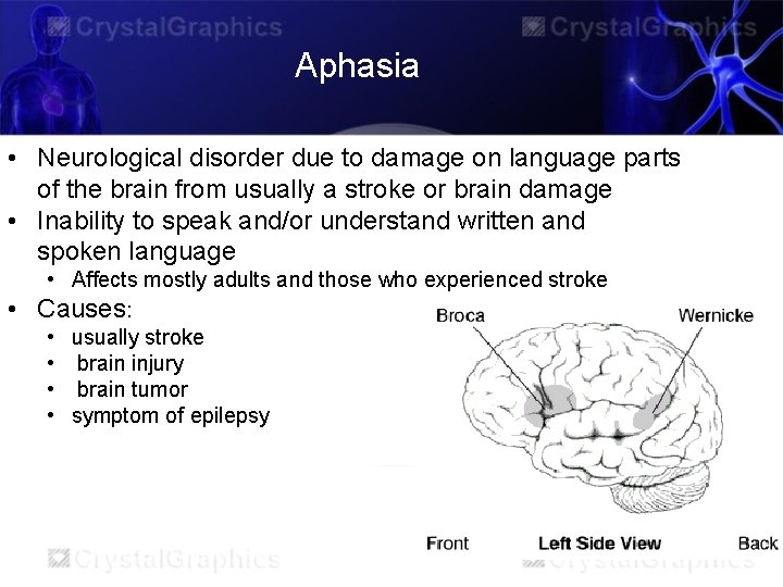 Aphasia • Neurological disorder due to damage on language parts of the brain from