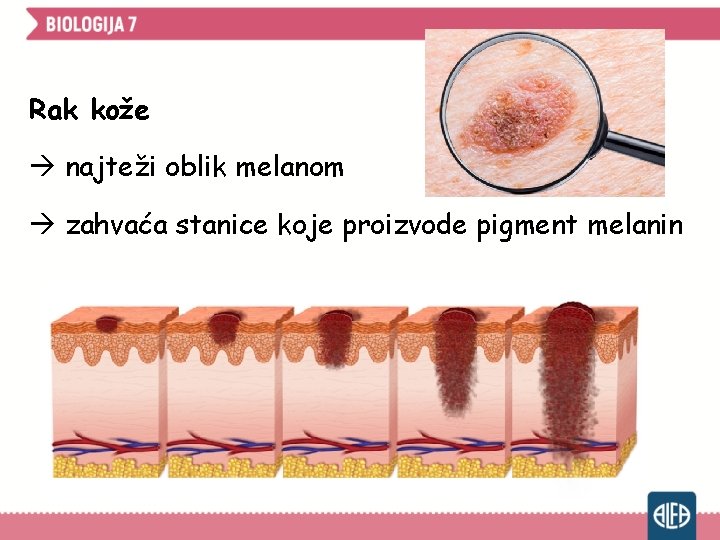 Rak kože najteži oblik melanom zahvaća stanice koje proizvode pigment melanin 