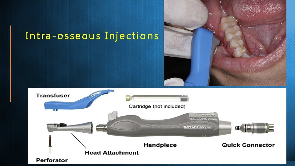 Intra-osseous Injections 
