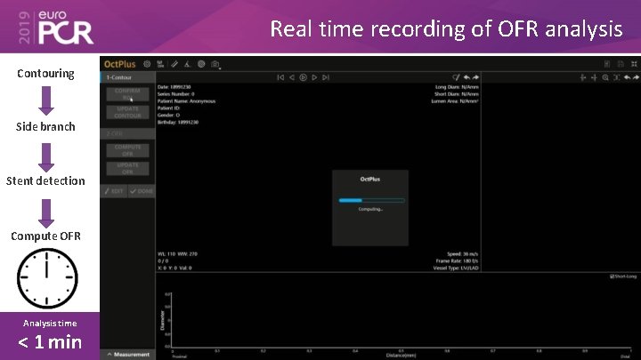 Real time recording of OFR analysis Contouring Side branch Stent detection Compute OFR Analysis
