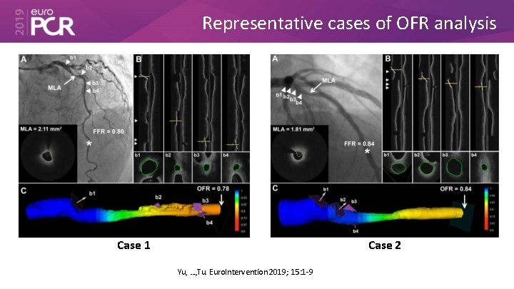 Representative cases of OFR analysis Case 1 Case 2 Yu, …, Tu. Euro. Intervention