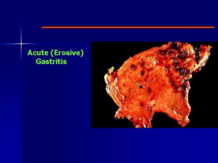 Acute (Erosive) Gastritis 