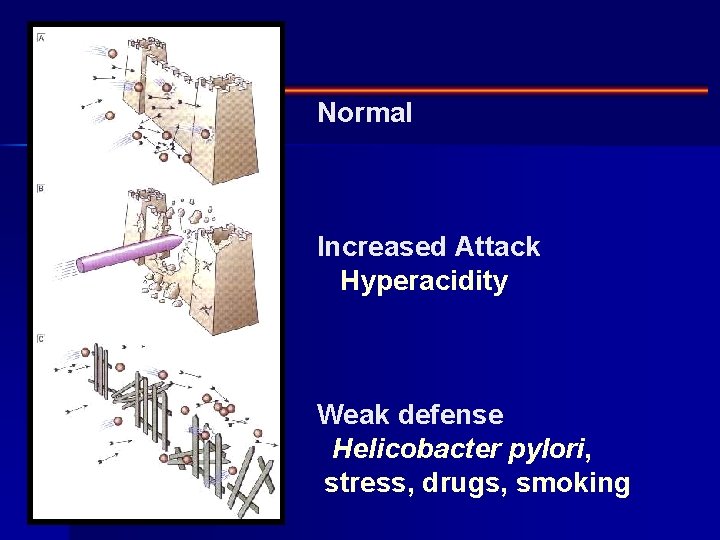 Normal Increased Attack Hyperacidity Weak defense Helicobacter pylori, stress, drugs, smoking 