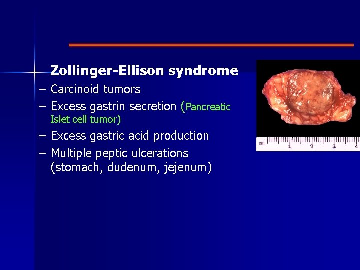 Zollinger-Ellison syndrome – Carcinoid tumors – Excess gastrin secretion (Pancreatic Islet cell tumor) –