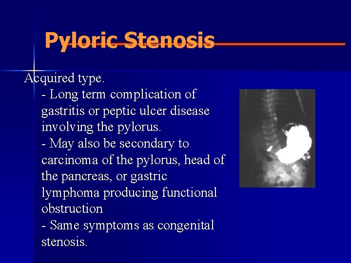 Pyloric Stenosis Acquired type. - Long term complication of gastritis or peptic ulcer disease