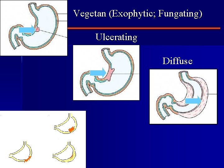 Vegetan (Exophytic; Fungating) Ulcerating Diffuse 