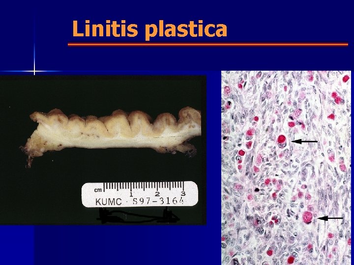 Linitis plastica 