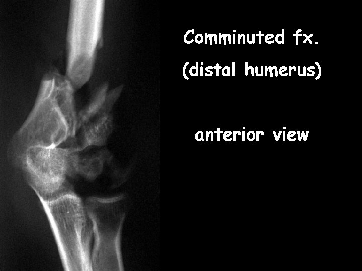 Comminuted fx. (distal humerus) anterior view 