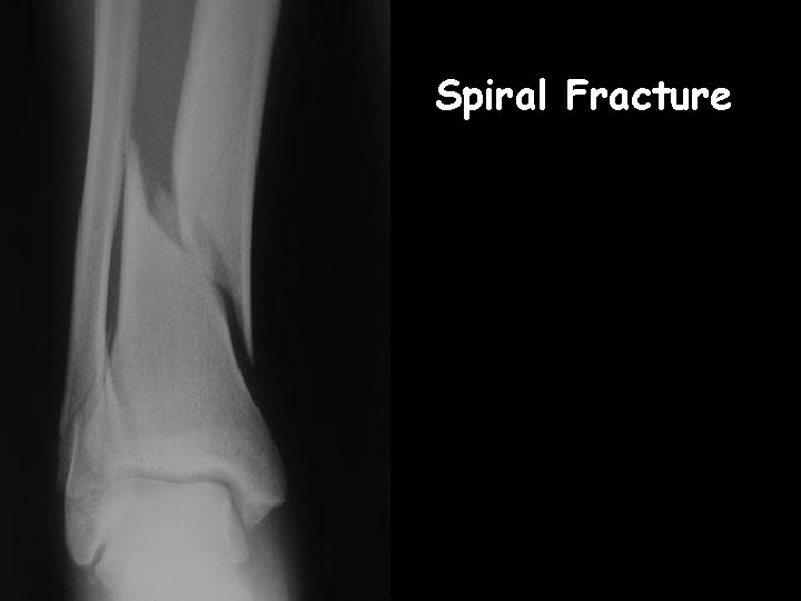 Spiral Fracture 