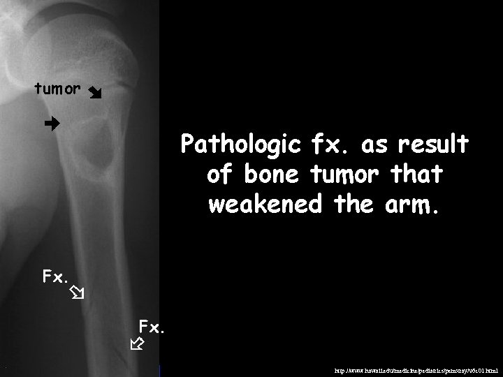 tumor Pathologic fx. as result of bone tumor that weakened the arm. Fx. http: