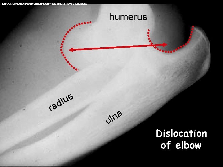 http: //www. vh. org/adult/provider/radiology/icmrad/skeletal/01 Trauma. html humerus ra s u i d a n