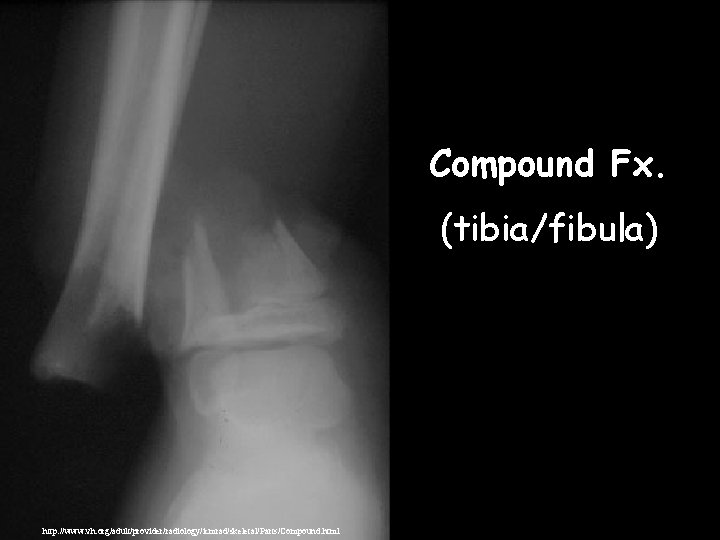 Compound Fx. (tibia/fibula) http: //www. vh. org/adult/provider/radiology/icmrad/skeletal/Parts/Compound. html 