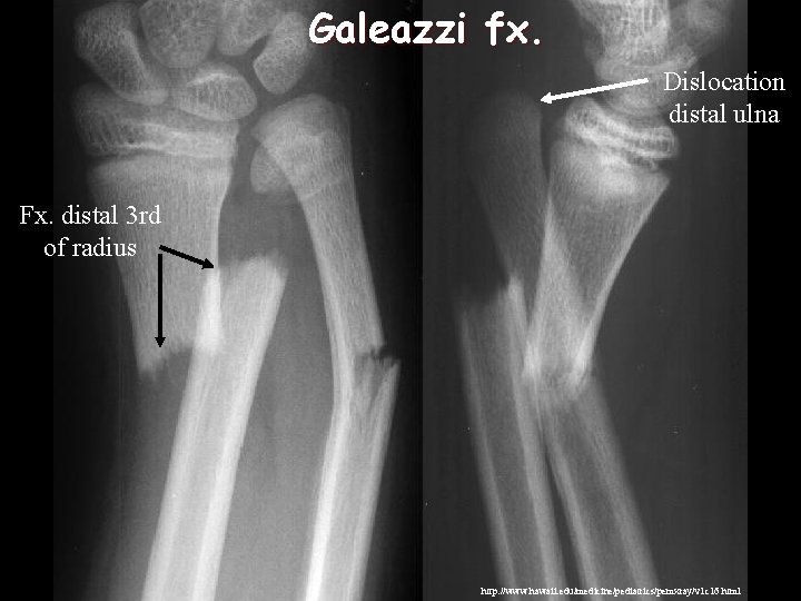 Galeazzi fx. Dislocation distal ulna Fx. distal 3 rd of radius http: //www. hawaii.