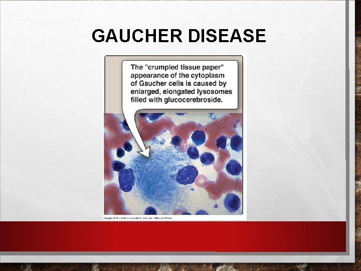 GAUCHER DISEASE 