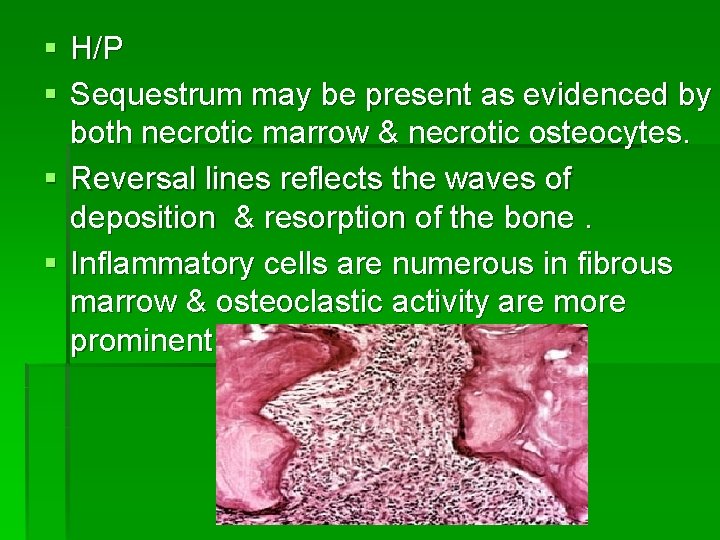 § H/P § Sequestrum may be present as evidenced by both necrotic marrow &