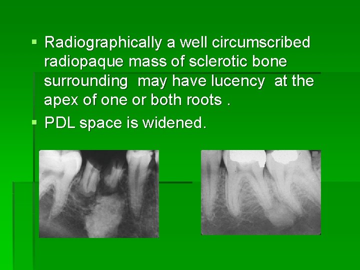 § Radiographically a well circumscribed radiopaque mass of sclerotic bone surrounding may have lucency