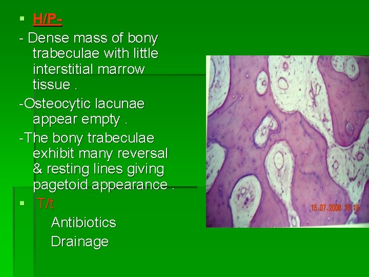 § H/P- Dense mass of bony trabeculae with little interstitial marrow tissue. -Osteocytic lacunae