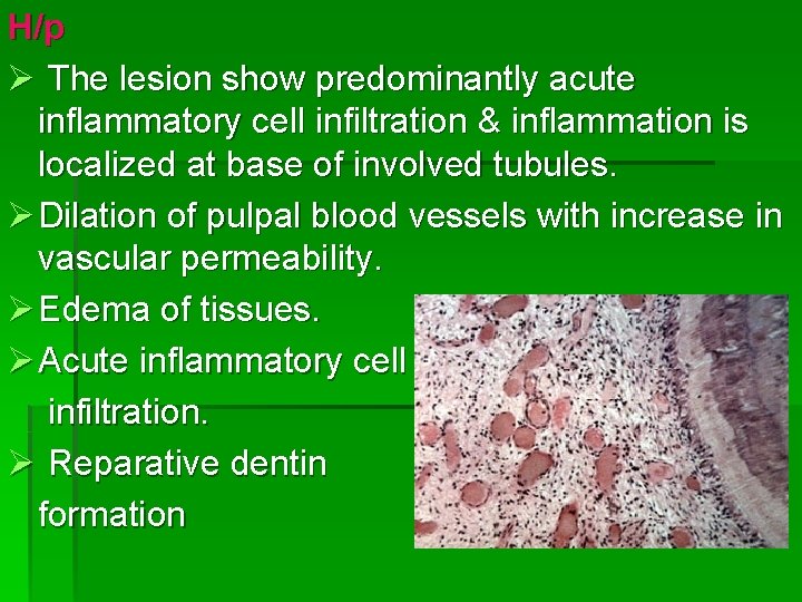 H/p Ø The lesion show predominantly acute inflammatory cell infiltration & inflammation is localized