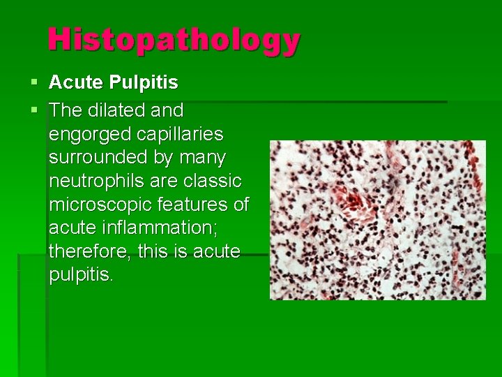 Histopathology § Acute Pulpitis § The dilated and engorged capillaries surrounded by many neutrophils