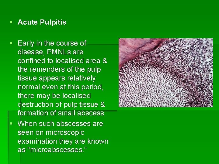 § Acute Pulpitis § Early in the course of disease, PMNLs are confined to