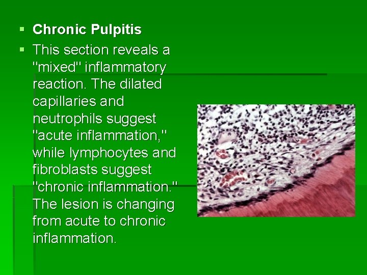 § Chronic Pulpitis § This section reveals a "mixed" inflammatory reaction. The dilated capillaries