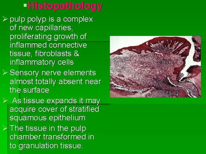 §Histopathology Ø pulp polyp is a complex of new capillaries, proliferating growth of inflammed