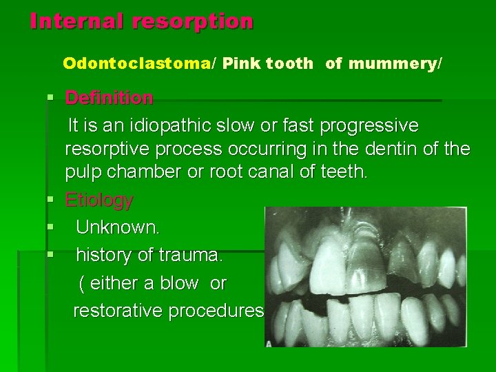 Internal resorption Odontoclastoma/ Pink tooth of mummery/ § Definition It is an idiopathic slow