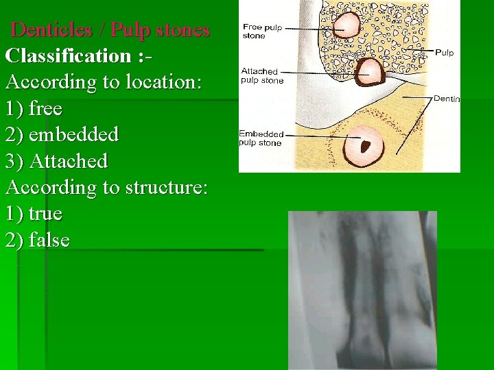 Denticles / Pulp stones Classification : According to location: 1) free 2) embedded 3)
