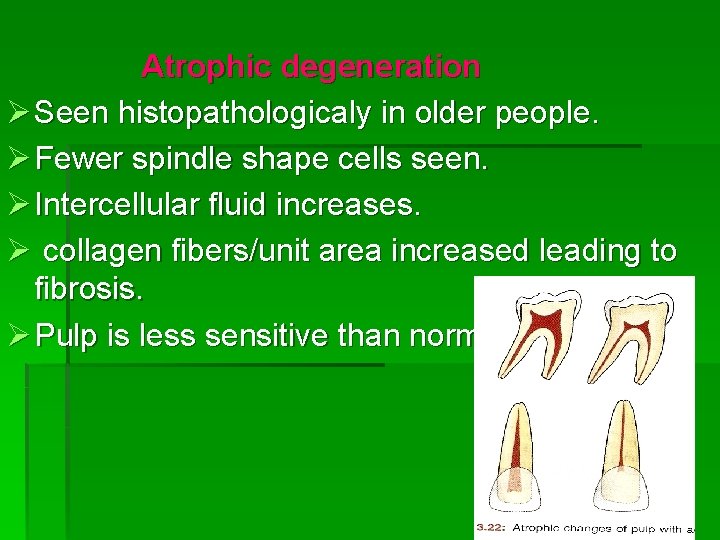Atrophic degeneration Ø Seen histopathologicaly in older people. Ø Fewer spindle shape cells seen.