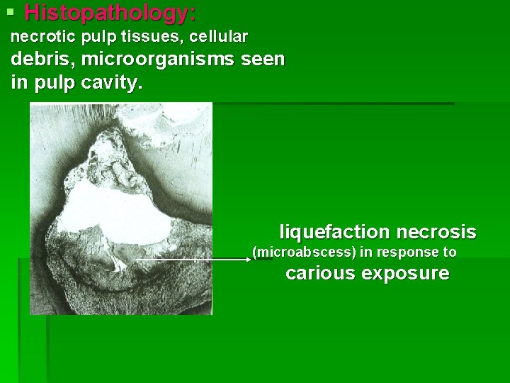 § Histopathology: necrotic pulp tissues, cellular debris, microorganisms seen in pulp cavity. liquefaction necrosis