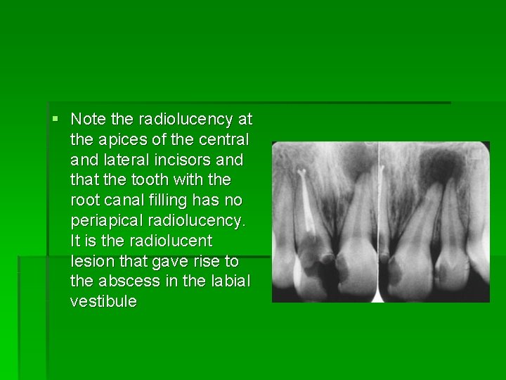 § Note the radiolucency at the apices of the central and lateral incisors and