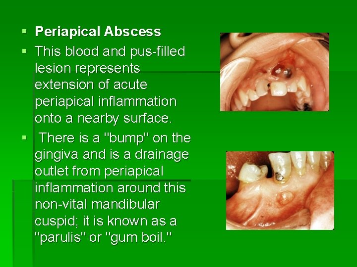 § Periapical Abscess § This blood and pus-filled lesion represents extension of acute periapical