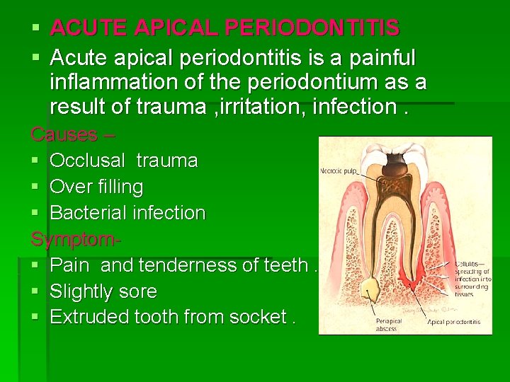 § ACUTE APICAL PERIODONTITIS § Acute apical periodontitis is a painful inflammation of the