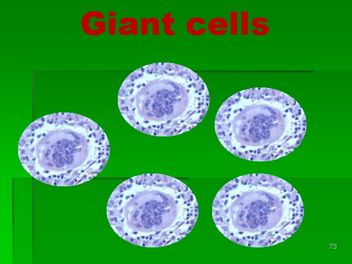 Giant cells 73 