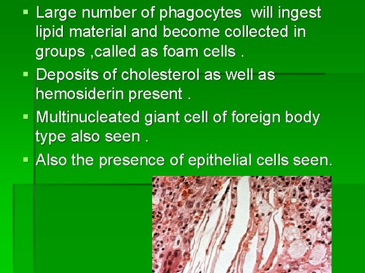 § Large number of phagocytes will ingest lipid material and become collected in groups