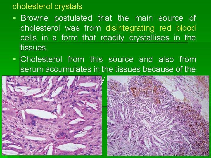 cholesterol crystals § Browne postulated that the main source of cholesterol was from disintegrating