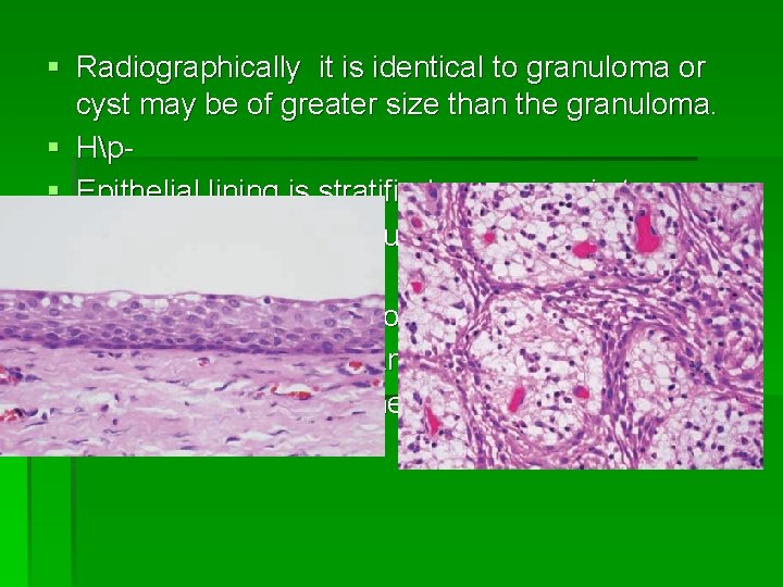 § Radiographically it is identical to granuloma or cyst may be of greater size