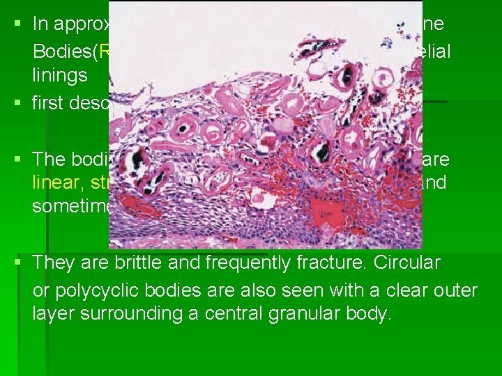 § In approximately 10% of radicular cysts, hyaline Bodies(Rushton’s bodies) are found in epithelial