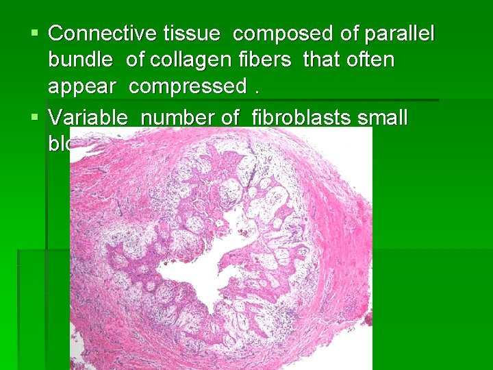 § Connective tissue composed of parallel bundle of collagen fibers that often appear compressed.