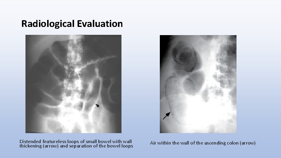 Radiological Evaluation Distended featureless loops of small bowel with wall thickening (arrow) and separation