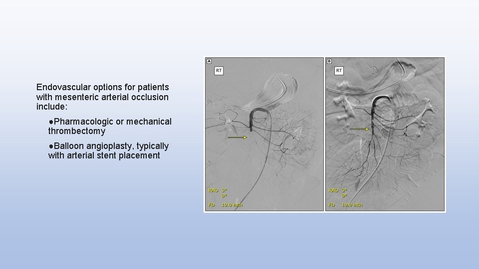 Endovascular options for patients with mesenteric arterial occlusion include: ●Pharmacologic or mechanical thrombectomy ●Balloon