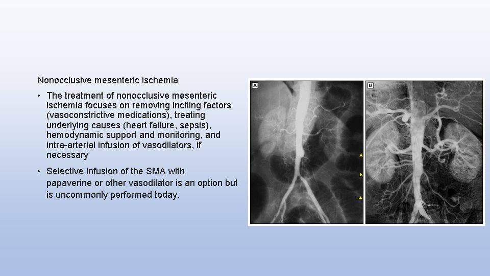 Nonocclusive mesenteric ischemia • The treatment of nonocclusive mesenteric ischemia focuses on removing inciting