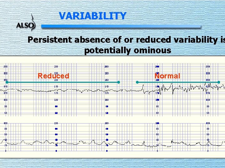 VARIABILITY Persistent absence of or reduced variability is potentially ominous Reduced Normal 