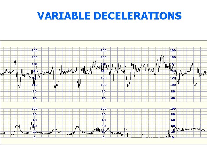 VARIABLE DECELERATIONS 