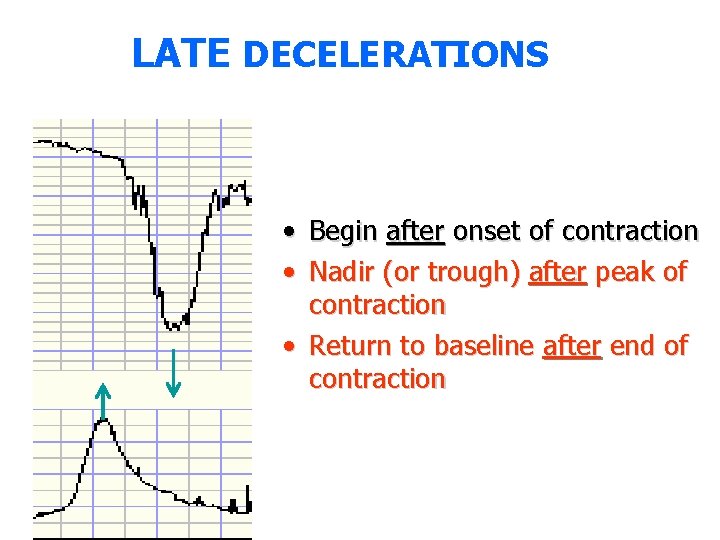 LATE DECELERATIONS • Begin after onset of contraction • Nadir (or trough) after peak