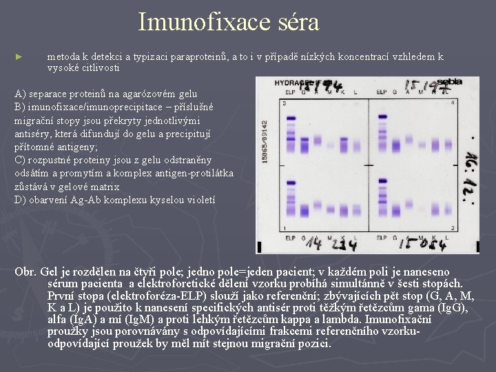 Imunofixace séra ► metoda k detekci a typizaci paraproteinů, a to i v případě