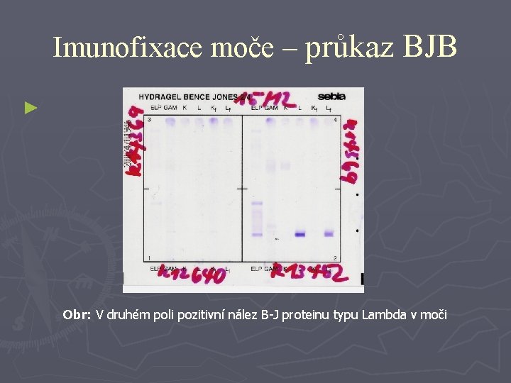 Imunofixace moče – průkaz BJB ► Obr: V druhém poli pozitivní nález B-J proteinu