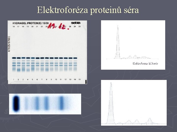 Elektroforéza proteinů séra 