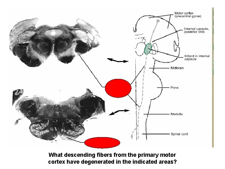 What descending fibers from the primary motor cortex have degenerated in the indicated areas?
